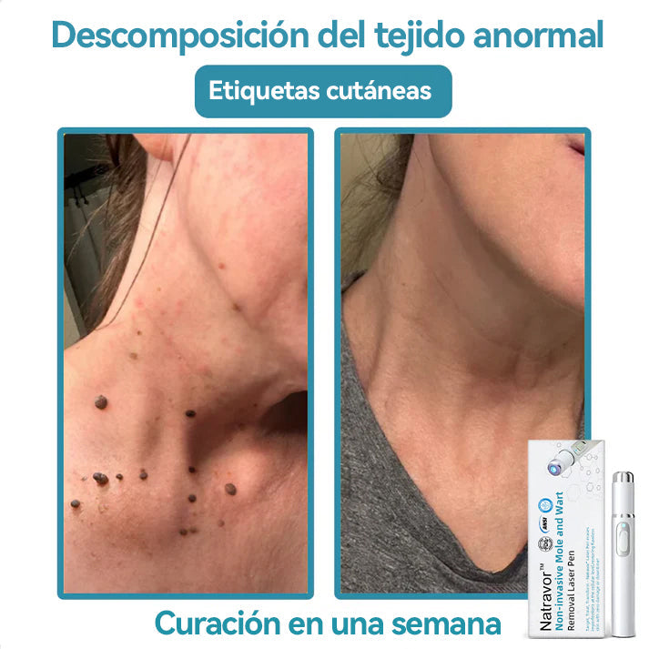 Lápiz láser no invasivo para la eliminación de lunares y verrugas Natravor™