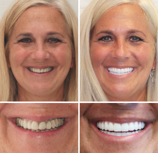 🦷Natravor™- Dentadura Premium(⏰Descuento por tiempo limitado, últimos 30 minutos.)