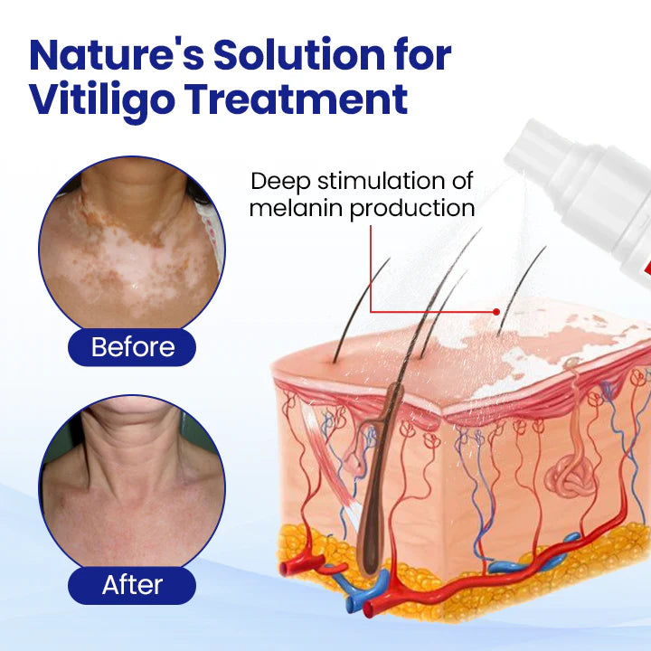 VitiClear Herbal Spray⭐