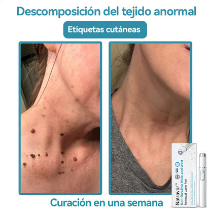 Lápiz láser no invasivo para la eliminación de lunares y verrugas Ｎatravor™