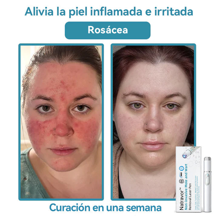 Lápiz láser no invasivo para la eliminación de lunares y verrugas Ｎatravor™