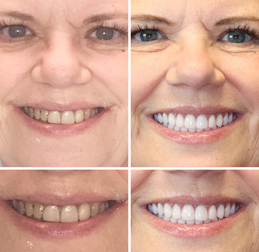 🦷Natravor™- Dentadura Premium（⏰Descuento por tiempo limitado, últimos 30 minutos.）