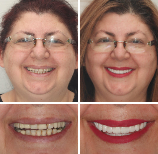 🦷Natravor™- Dentadura Premium（⏰Descuento por tiempo limitado, últimos 30 minutos.）