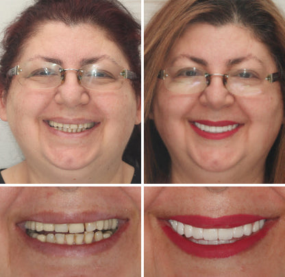 🦷Natravor™- Dentadura Premium（⏰Descuento por tiempo limitado, últimos 30 minutos.）