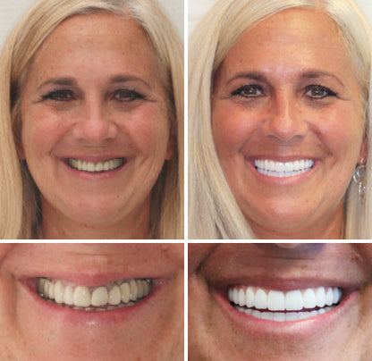 🦷Natravor™- Dentadura Premium（⏰Descuento por tiempo limitado, últimos 30 minutos.）