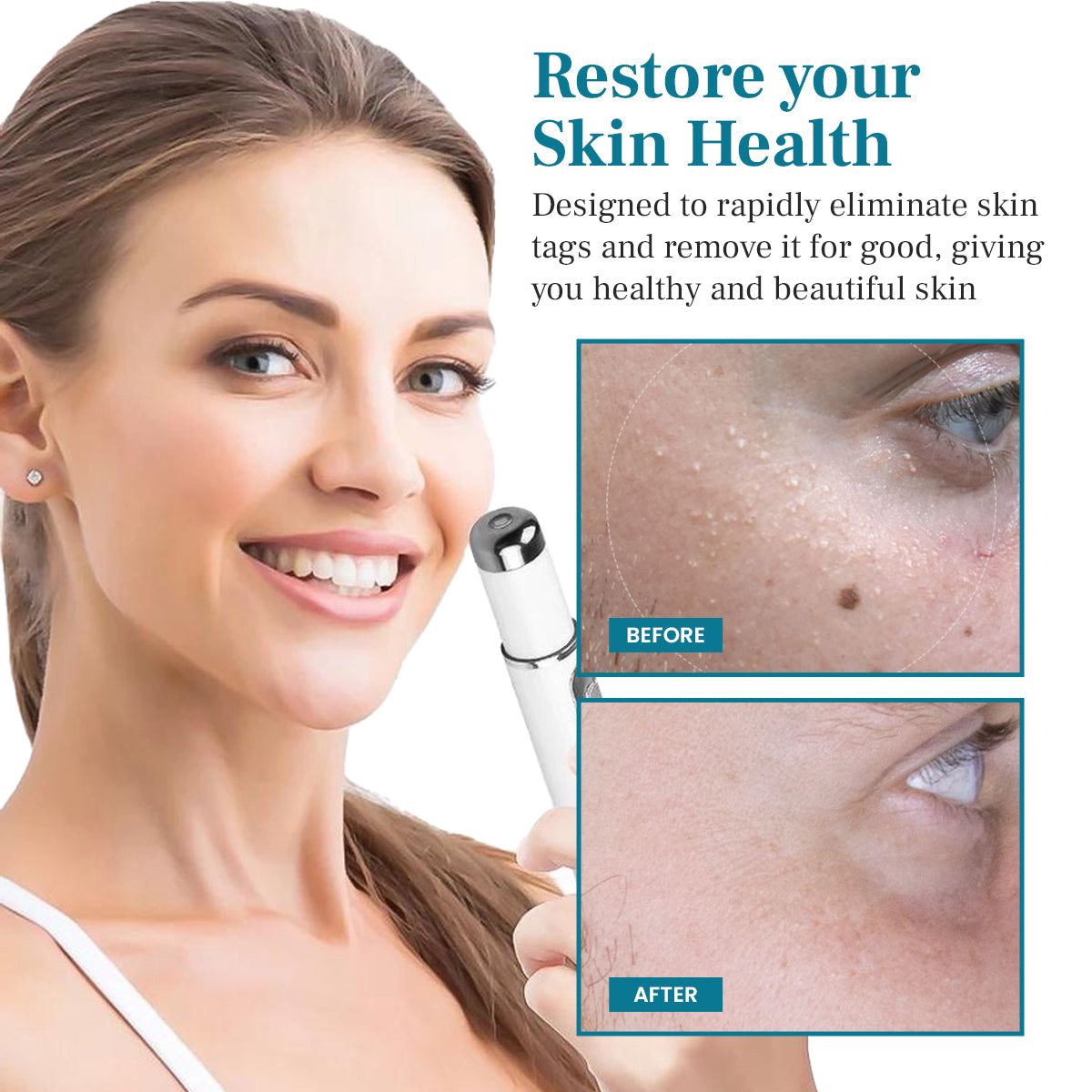 Natravor® LumeSkin Mole and Wart Removal Laser Pen