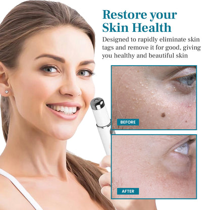 Natravor® LumeSkin Mole and Wart Removal Laser Pen